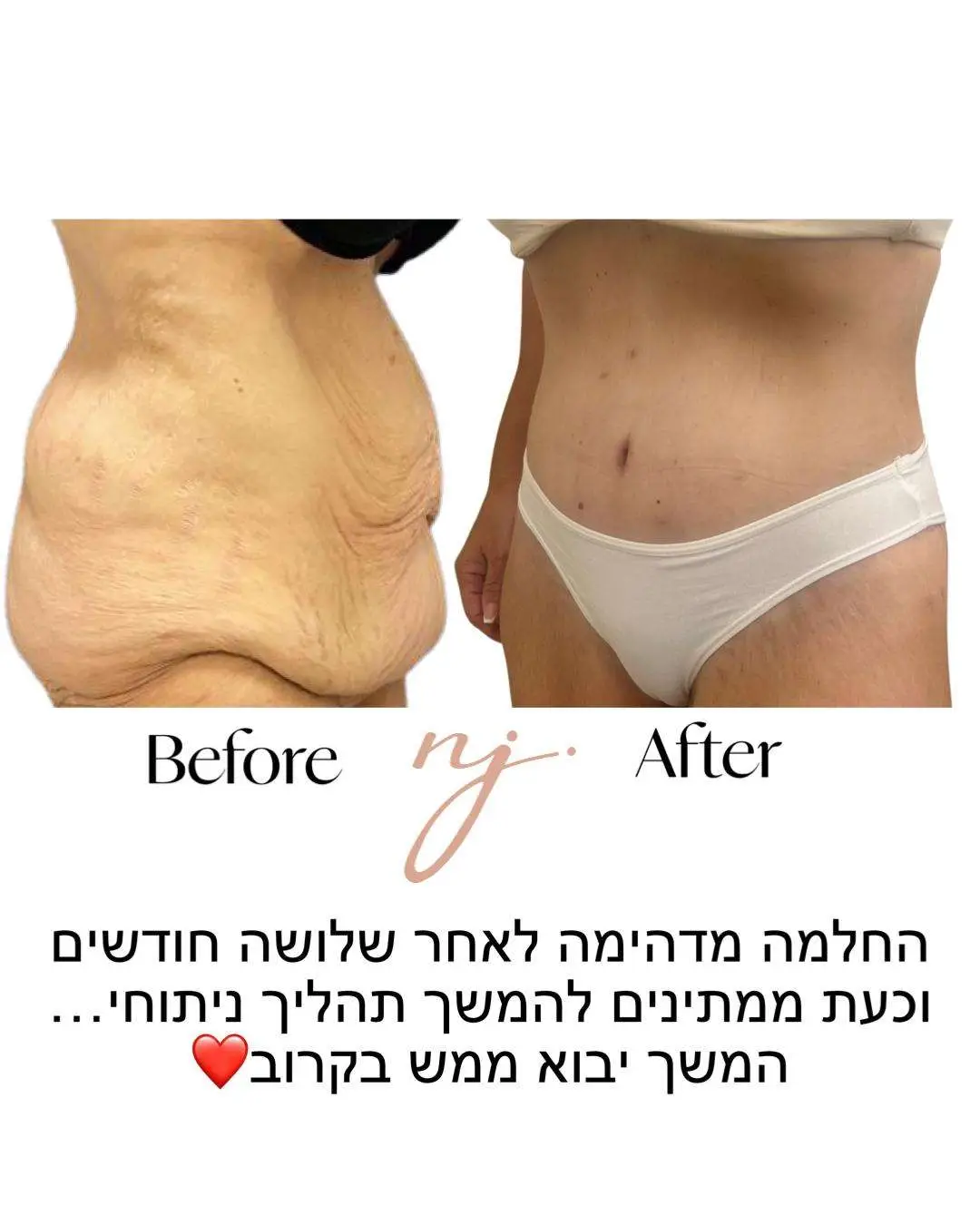 בטן היקפית 2